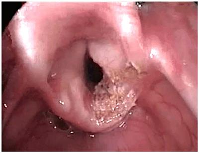 Surgical Options for Pediatric Bilateral Vocal Cord Palsy: State of the Art